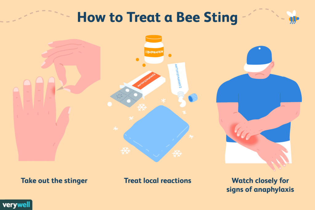 How To Treat Bee Stings?